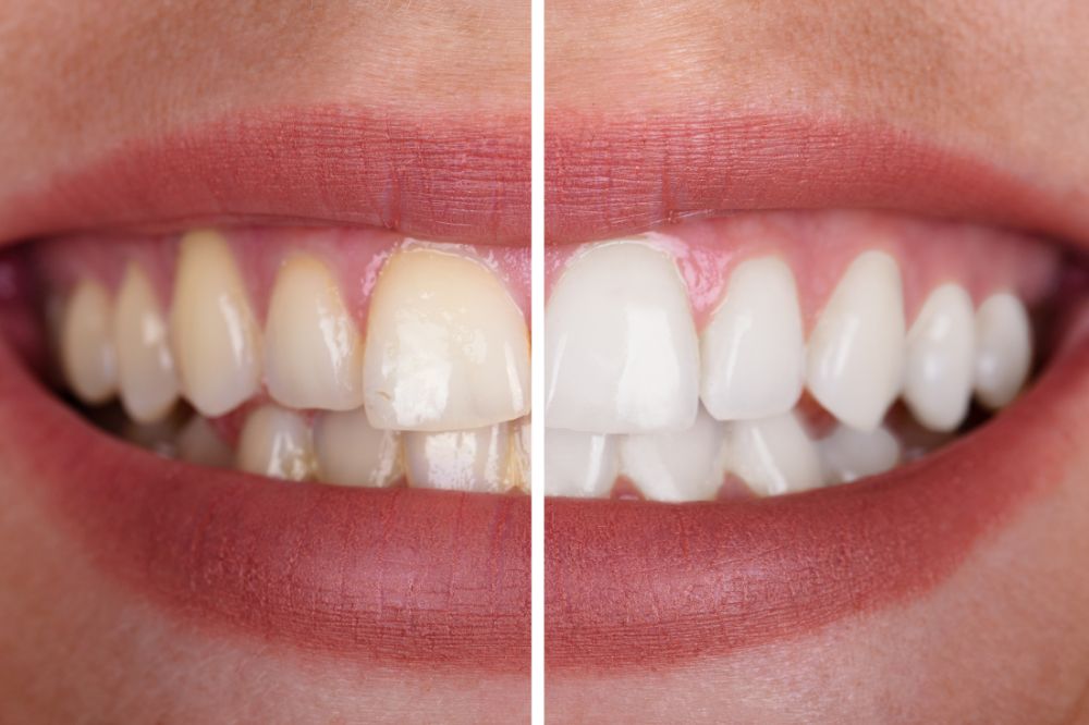 Can Whitening Damage Your Teeth Myth Busted!