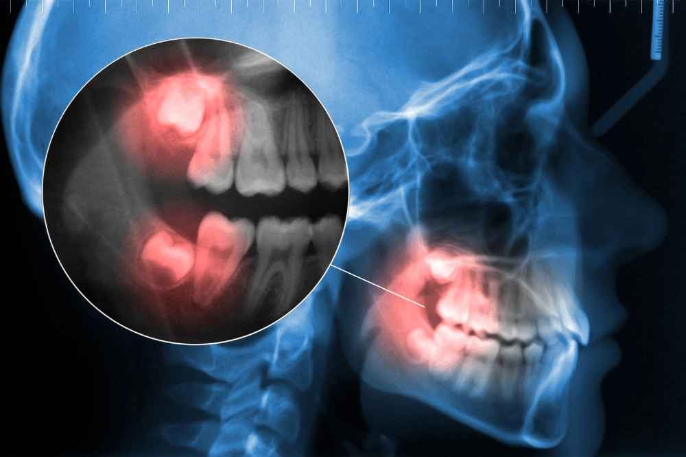 Toothache at Midnight We’ve Got You! - Dentist Acton