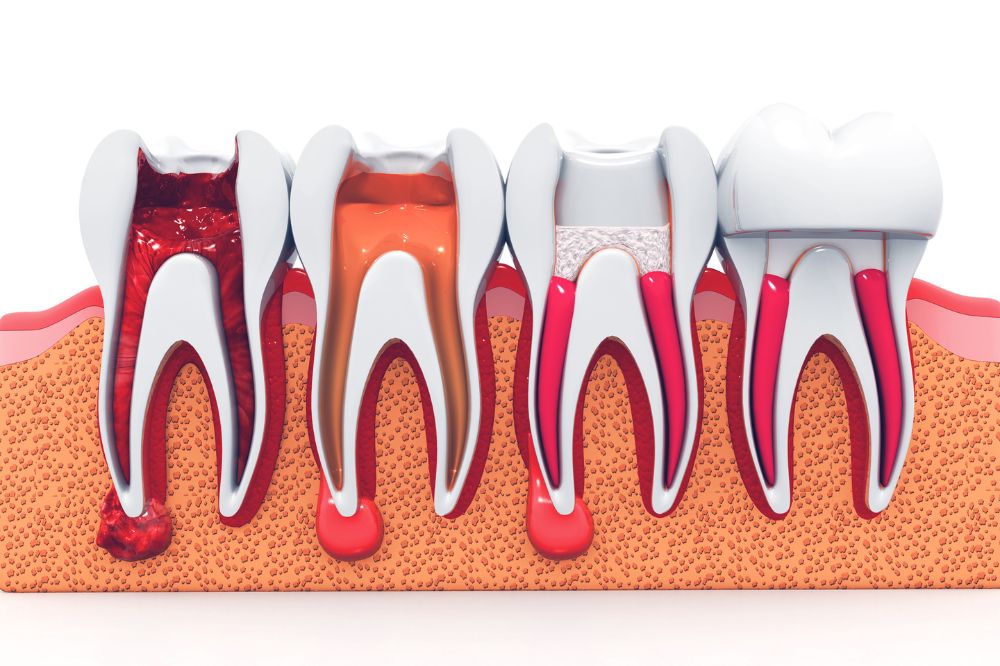 Root Canal Treatment Explained